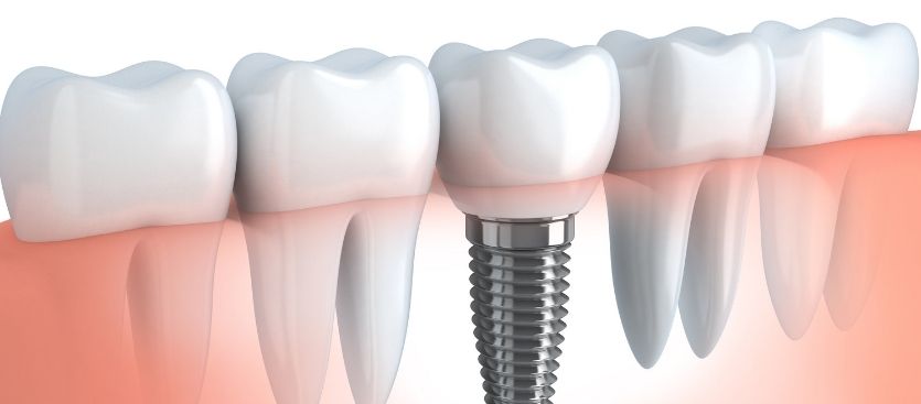 implantes dentales en Campo de Criptana