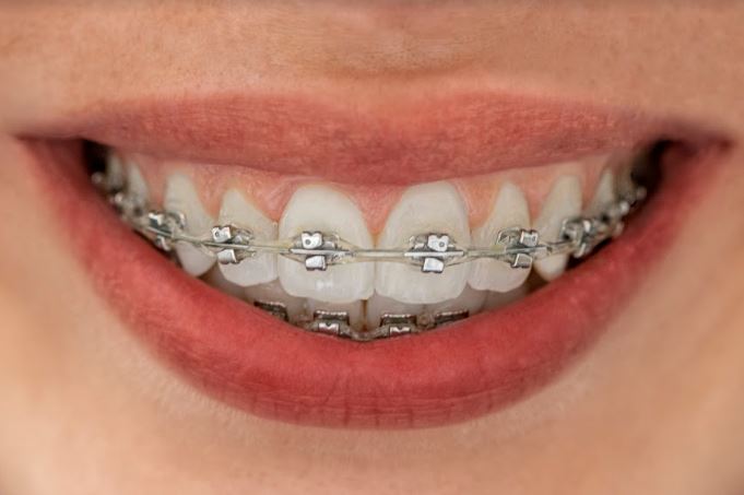 ortodoncia convencional