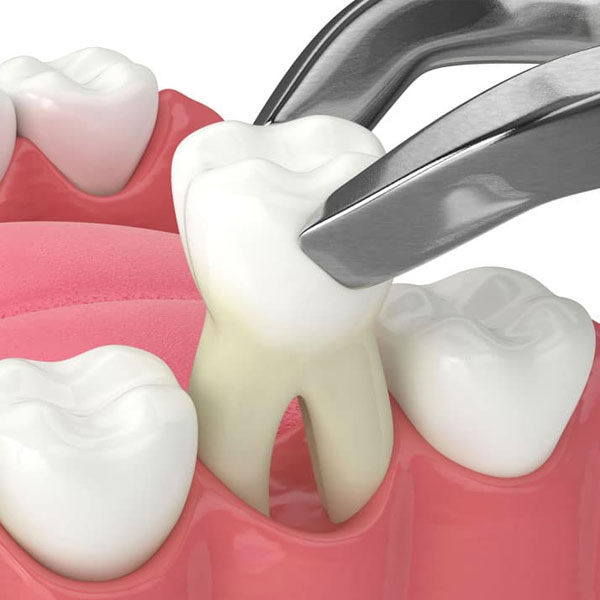 Cirugía de extracción de piezas dentales