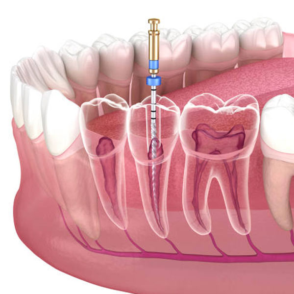Cirugía de tratamiento de conductos o endodoncia