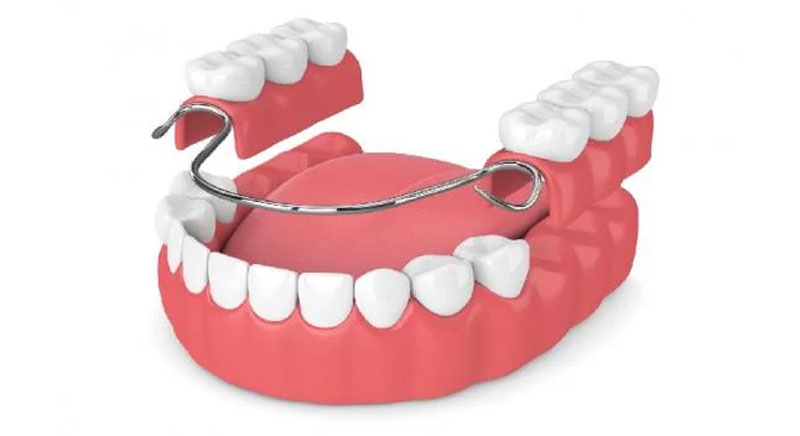 Ventajas y desventajas de las protesis dentales removibles