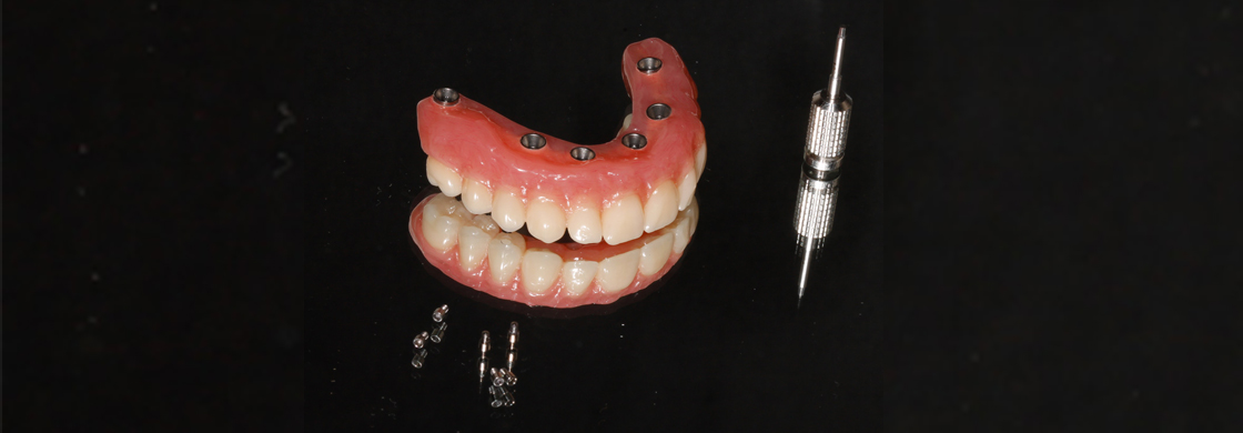 Protesis dental hibrida