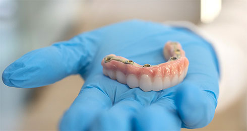 Implante dental campo de criptana montiel