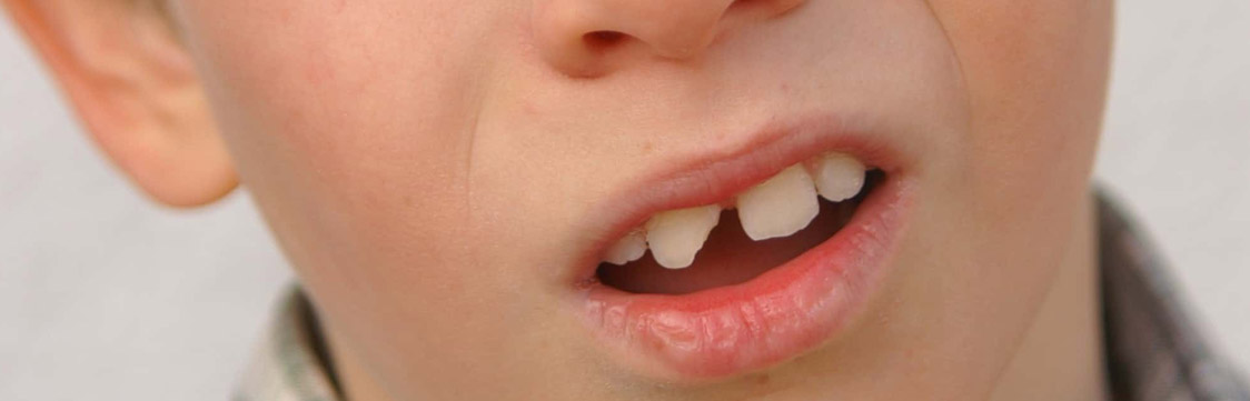 Odontopediatría fractura en diente de niños